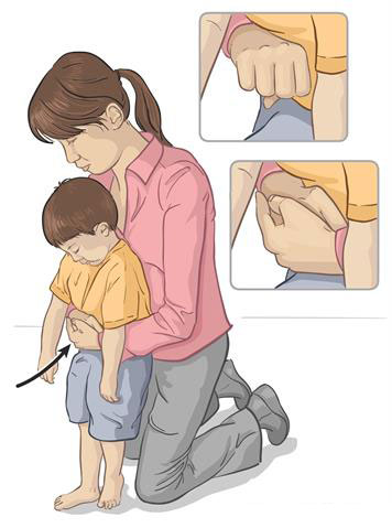 manovra disostruzione